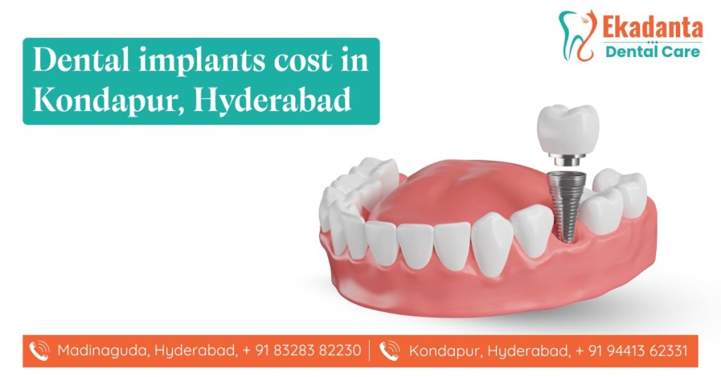 Dental Implants Cost in Kondapur
