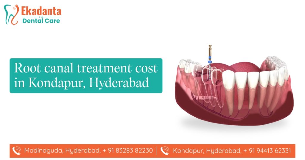 Root Canal Treatment Cost in Kondapur