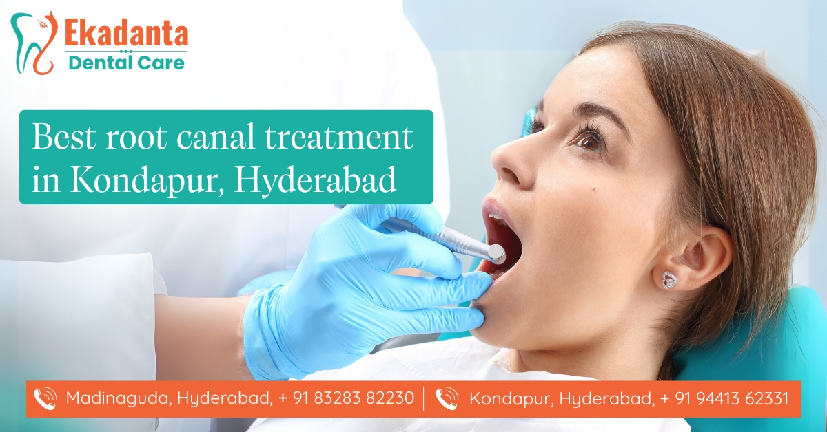Best Root Canal Treatment in Kondapur, Hyderabad